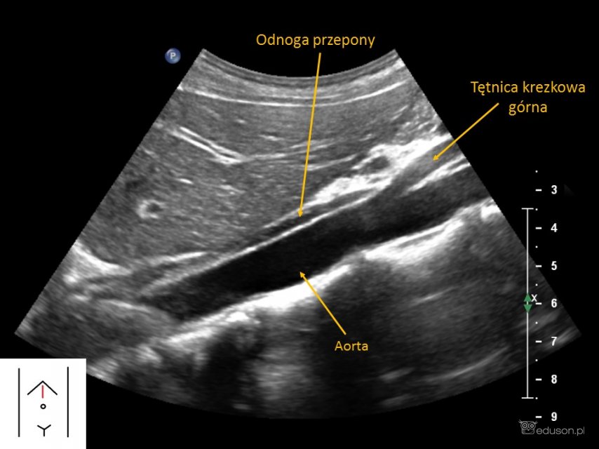 Odnoga przepony widoczna w przekroju podłużnym pośrodkowym (na wysokości aorty). Głowica konweksowa.