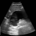 Zmiana płynowa w nadbrzuszu | Portal wymiany wiedzy o ultrasonografii - Eduson