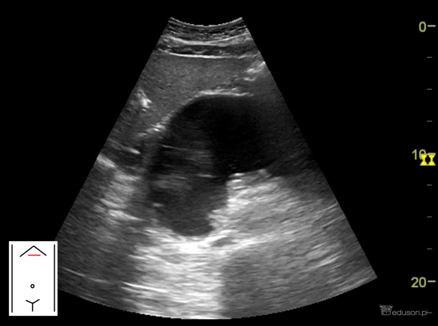 Zmiana płynowa w nadbrzuszu - Portal wymiany wiedzy o ultrasonografii - Eduson
