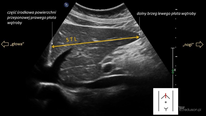 Punkty pomiarowe podczas oceny wymiaru podłużnego lewego płata wątroby w linii środkowej ciała (STL).