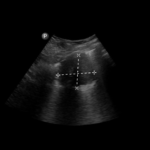 Rak gruczołowy płuca - Portal wymiany wiedzy o ultrasonografii - Eduson