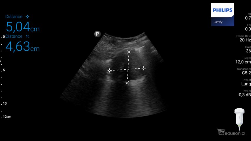 Rak gruczołowy płuca - Portal wymiany wiedzy o ultrasonografii - Eduson