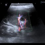 Gorączkujące dziecko z rdzeniowym zanikiem mięśni. - Portal wymiany wiedzy o ultrasonografii - Eduson