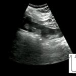 Pierwsze badanie ultrasonograficzne jamy brzusznej 82-letniego mężczyzny - Portal wymiany wiedzy o ultrasonografii - Eduson