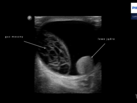 Powiększenie moszny u 2-letniego pacjenta - Portal wymiany wiedzy o ultrasonografii - Eduson