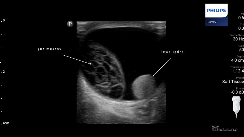 Powiększenie moszny u 2-letniego pacjenta | Portal wymiany wiedzy o ultrasonografii - Eduson
