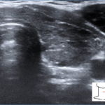 Autoimmunologiczne zapalenie tarczycy - Portal wymiany wiedzy o ultrasonografii - Eduson