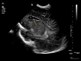 Torbiele w okolicy szczytów rogów przednich komór bocznych u noworodka. - Portal wymiany wiedzy o ultrasonografii - Eduson