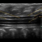 jak wygląda prawidłowy obraz USG kanału kręgowego | Portal wymiany wiedzy o ultrasonografii - Eduson