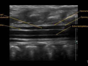 jak wygląda prawidłowy obraz USG kanału kręgowego | Portal wymiany wiedzy o ultrasonografii - Eduson