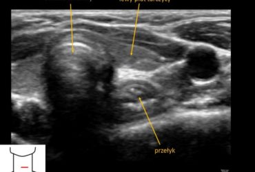jak wygląda prawidłowy obraz USG jelit | Portal wymiany wiedzy o ultrasonografii - Eduson