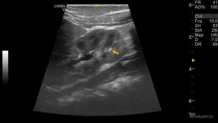 Mały złóg w kielichu dolnym prawej nerki u 3-miesięcznego niemowlęcia (strzałka). Średnica złogu 2,3mm. Głowica liniowa L6-12. Aparat GE LOGIQ V2.