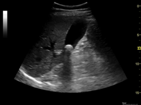 Kamica pęcherzyka żółciowego - Portal wymiany wiedzy o ultrasonografii - Eduson