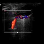 Sekwestracja płucna | Portal wymiany wiedzy o ultrasonografii - Eduson