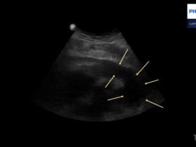 Obrzęk płuc w przezklatkowym badaniu usg płuc na wizycie domowej | Portal wymiany wiedzy o ultrasonografii - Eduson
