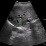Poszerzenie PŻW u pacjentki po cholecystektomii. | Portal wymiany wiedzy o ultrasonografii - Eduson