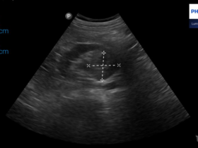 Guz prawej nerki - badanie "point of care" - Portal wymiany wiedzy o ultrasonografii - Eduson