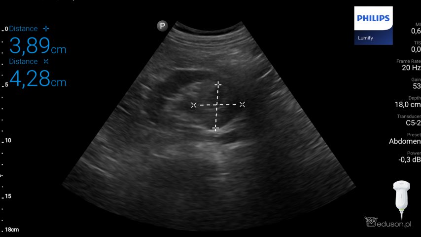 Guz prawej nerki - badanie "point of care" - Portal wymiany wiedzy o ultrasonografii - Eduson