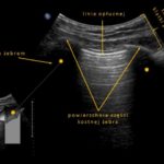 jak wygląda prawidłowy obraz USG płuc | Portal wymiany wiedzy o ultrasonografii - Eduson