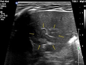 Noworodek z wrodzonym przerostem nadnerczy | Portal wymiany wiedzy o ultrasonografii - Eduson