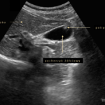 Polip pęcherzyka żółciowego w badaniu usg - i co dalej? | Portal wymiany wiedzy o ultrasonografii - Eduson