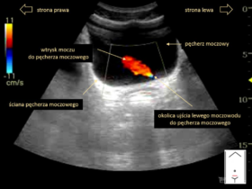 jak wygląda prawidłowy obraz USG pęcherza moczowego | Portal wymiany wiedzy o ultrasonografii - Eduson