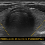 jak wygląda prawidłowy obraz USG tarczycy | Portal wymiany wiedzy o ultrasonografii - Eduson