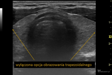 jak wygląda prawidłowy obraz USG tarczycy | Portal wymiany wiedzy o ultrasonografii - Eduson