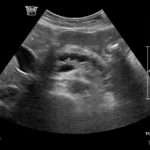 Przewlekłe zapalenie trzustki. | Portal wymiany wiedzy o ultrasonografii - Eduson