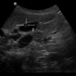 Obrazy ultrasonograficzne pęcherzyka żółciowego w głowicy LUMIFY - Portal wymiany wiedzy o ultrasonografii - Eduson
