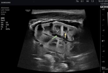 Obraz ultrasonograficzny nerek u noworodków, dzieci i młodzieży | Portal wymiany wiedzy o ultrasonografii - Eduson