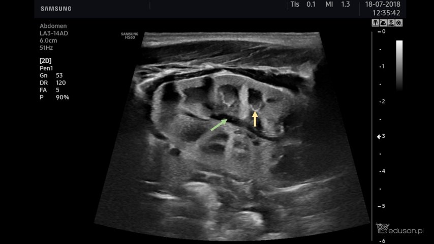 Obraz ultrasonograficzny nerek u noworodków, dzieci i młodzieży - Portal wymiany wiedzy o ultrasonografii - Eduson
