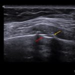 Kobieta z bólem klatki piersiowej po urazie komunikacyjnym. | Portal wymiany wiedzy o ultrasonografii - Eduson