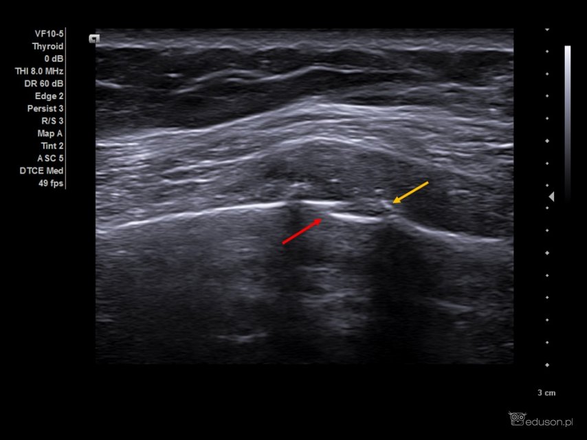 Kobieta z bólem klatki piersiowej po urazie komunikacyjnym. | Portal wymiany wiedzy o ultrasonografii - Eduson