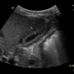 Pogrubiała ściana pęcherzyka żółciowego w badaniu usg - przyczyny - Portal wymiany wiedzy o ultrasonografii - Eduson