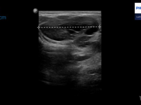 Choroba Castlemana ślinianki przyusznej | Portal wymiany wiedzy o ultrasonografii - Eduson