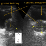 przezbrzuszne badanie gruczołu krokowego - Portal wymiany wiedzy o ultrasonografii - Eduson