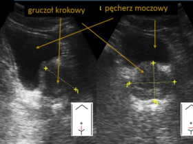 przezbrzuszne badanie USG gruczołu krokowego | Portal wymiany wiedzy o ultrasonografii - Eduson