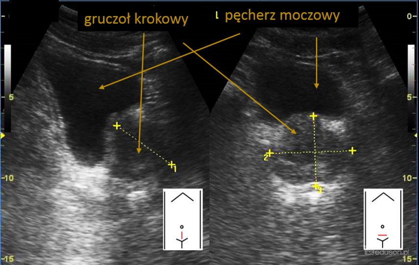 przezbrzuszne badanie gruczołu krokowego - Portal wymiany wiedzy o ultrasonografii - Eduson
