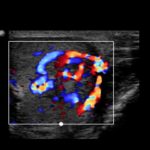 Ginekomastia u nastolatka | Portal wymiany wiedzy o ultrasonografii - Eduson