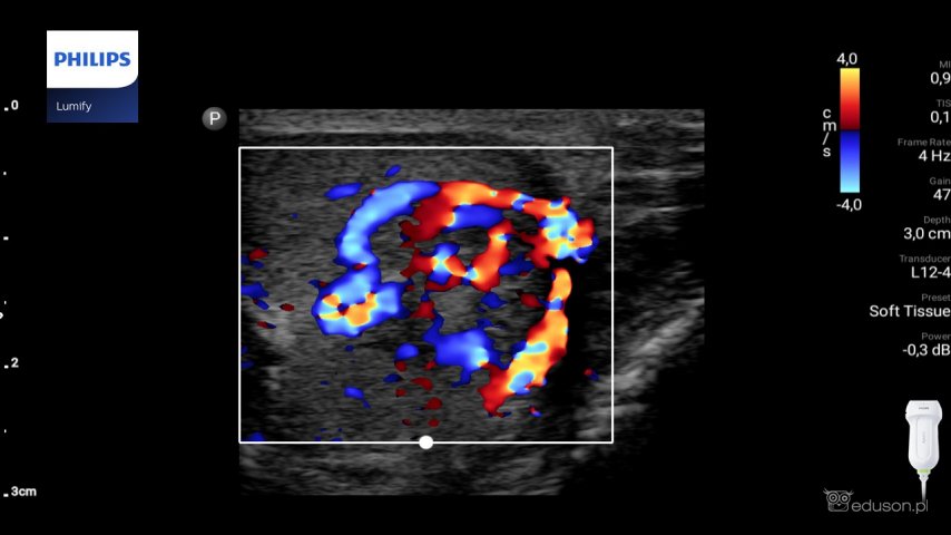 Ginekomastia u nastolatka | Portal wymiany wiedzy o ultrasonografii - Eduson