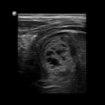 Krwawienie do nadnerczy u noworodków | Portal wymiany wiedzy o ultrasonografii - Eduson