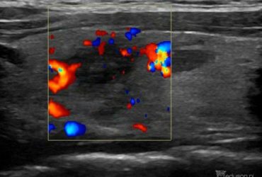 64-letnia kobieta z bólem szyi | Portal wymiany wiedzy o ultrasonografii - Eduson
