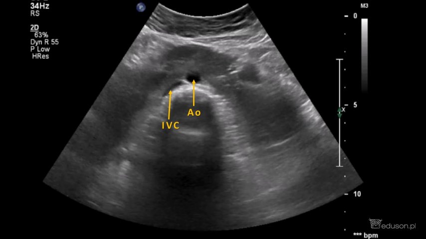 Przekrój poprzeczny przez cieśń nerki podkowiastej. Grzbietowo do cieśni widoczna jest żyła główna dolna (IVC) i aorta (Ao).