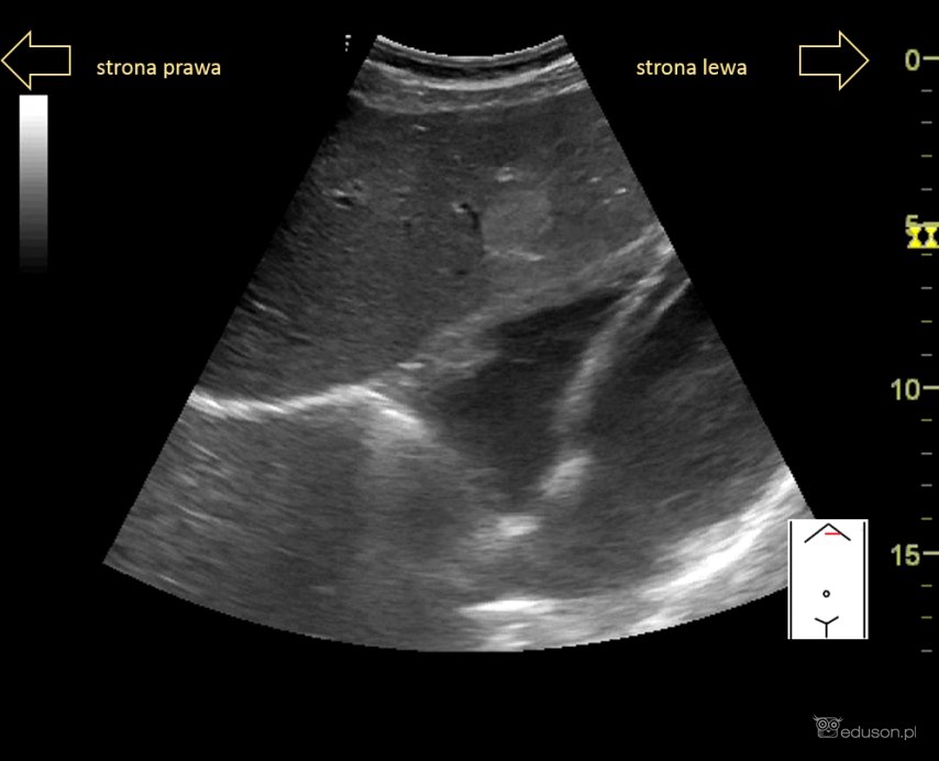 Łagodne zmiany ogniskowe wątroby - Portal wymiany wiedzy o ultrasonografii - Eduson