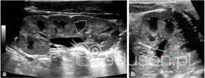 Poszerzenie układu kielichowo-miedniczkowego u dzieci | Portal wymiany wiedzy o ultrasonografii - Eduson